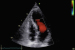 Abb. 2: Thrombus