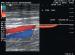 Abb. 8: Duplexsonographie - V. fem. sup.