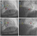 Abb. 2: Katheterablation