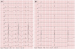 Aktuelles Bild - Abb. 4: AAI-Stimulation