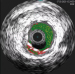 Abb. 3: IVUS
