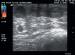 Abb. 13: Duplexsonographie - Thrombophlebitis