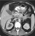 Abb. 7: Abdomen-CT