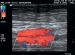 Abb. 17: Duplexsonographie - Postthrombotisches Syndrom