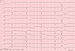 Abb. 1: EKG