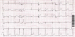 Abb. 1: EKG