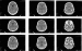 Abb. 2: Computertomographie nach 2 Tagen