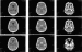 Abb. 3: Computertomographie – Rezidiv