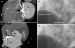 Abb. 1: Amplatzer-Septal-Occluder