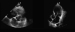 Abb. 2: POCUS - PSAX