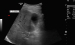 Abb. 1: Pfortaderthrombose