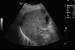 Abb. 2: Pfortaderthrombose