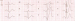 Abb. 2: EKG