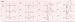 Abb. 5: EKG