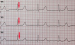 Abb. 2: EKG