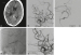 Abb. 5a-e: Mykotisches Aneurysma
