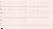 Abb. 4: EKG