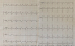 Abb. 1: EKG