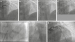 Abb. 6a-g: Angiogramm