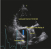 Abb. 10: Single Ventricle