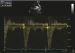 Abb. 21: PW-Doppler