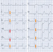Aktuelles Bild - Abb. 1: EKG