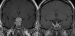 Abb. 5: Hypophysenchirurgie