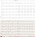 Abb. 3: EKG