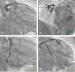 Aktuelles Bild - Abb. 4a-d: Angiographie