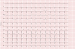 Abb. 5: EKG