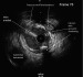 Abb. 4: IVUS