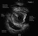Abb. 5: IVUS