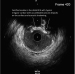 Abb. 6: IVUS