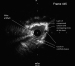 Abb. 9: IVUS