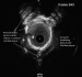 Aktuelles Bild - Abb. 16: IVUS