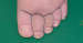 Abb. 4: Papillomatosis  cutis lymphostatica