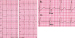 Abb. 1: EKG