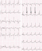 Abb. 2: EKG