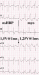 Abb. 3: EKG