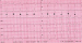 Abb. 4: EKG