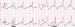 Abb. 5: EKG