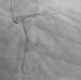 Aktuelles Bild - Abb. 1: Koronarangiographie - CX