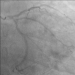 Abb. 2: Koronarangiographie - CX