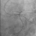 Abb. 8: PTCA - LAD/CX/OM/CX