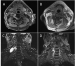 Abb. 3A-D: Prä- und postoperatives MRT
