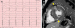 Aktuelles Bild - Abb. 1: EKG-Veränderungen