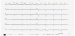 Aktuelles Bild - Abb. 1: EKG