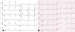 Aktuelles Bild - Abb. 1: Ablation