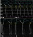 Abb. 2: HRA-Katheter -  His-Katheter - CS-Katheter - RVA-Katheter