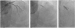 Abb. 9a-c: Angiographie